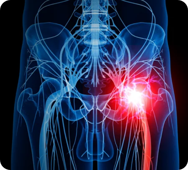 sciatica-diseases